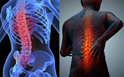 OSTEOPOROZ