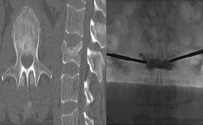 VERTEBROPLASİ KİFOPLASTİ